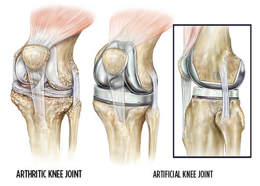 Joint Replacement Doctor in Jogeshwari